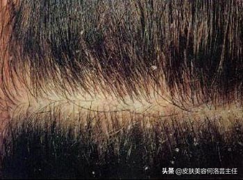 秋天干燥头皮屑怎么去除,光头头皮屑多怎么去除最简单方法