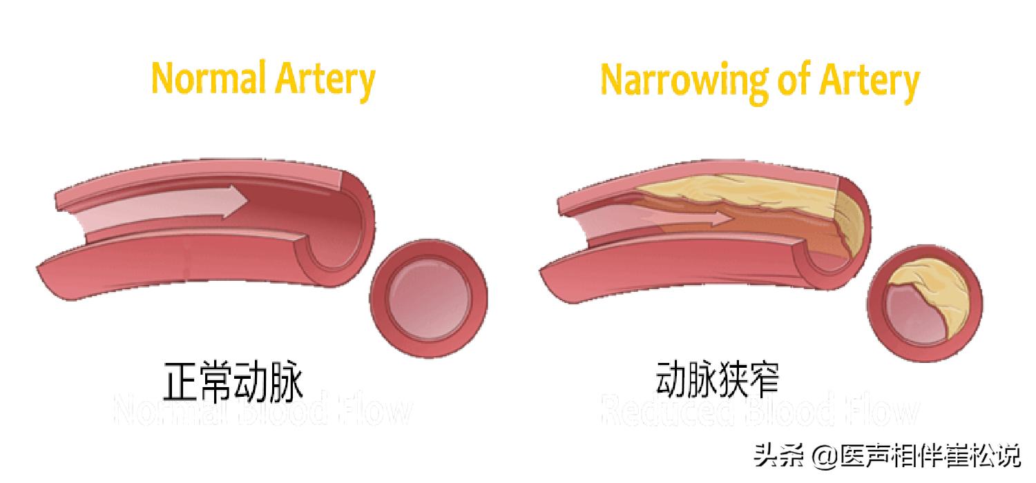 脑梗腔梗应该挂号什么科,腔梗和脑梗有什么区别