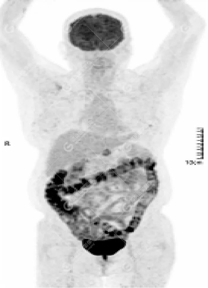 女性防癌检查科普,妇女宫颈癌及乳腺癌筛查情况年报