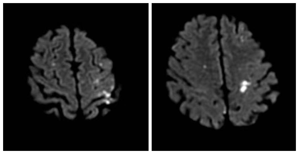 75岁老人多发性脑梗死，DSA介入治疗打通大脑“生命线”