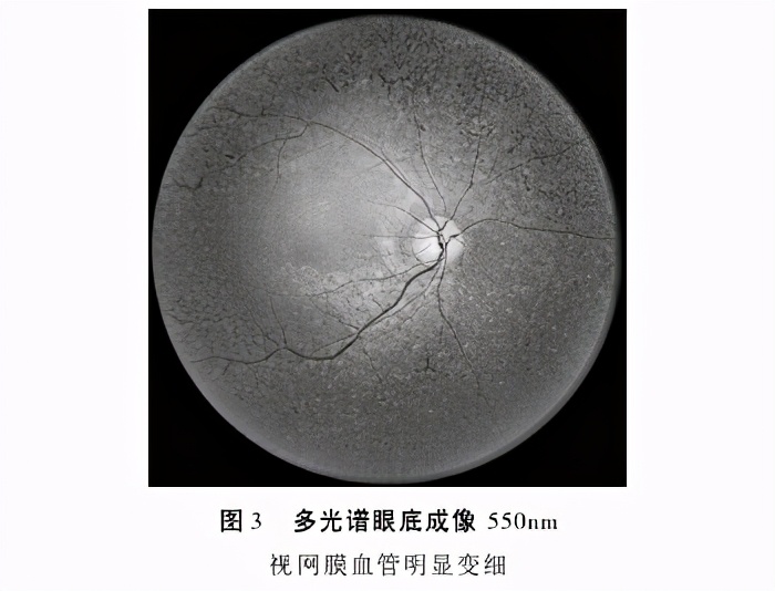 视网膜色素变性是一种常见眼病吗,视网膜色素变性是什么病