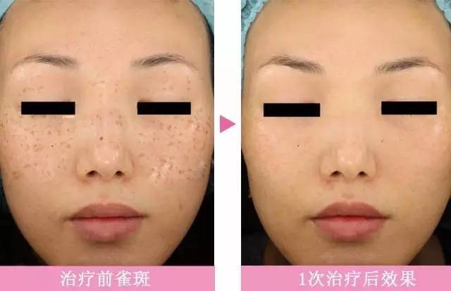 脸上有斑用什么护肤品祛斑效果好,40岁女人脸上长斑怎样有效祛斑