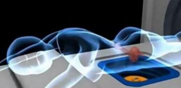 不开刀的子宫肌瘤消融术,不动手术做子宫肌瘤叫什么仪器