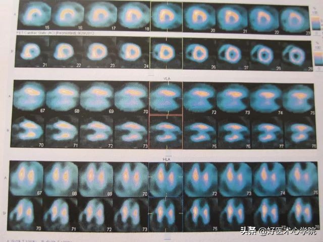 肥厚性心肌病伴心肌梗死,心尖部室壁瘤和心肌穿孔能救活吗