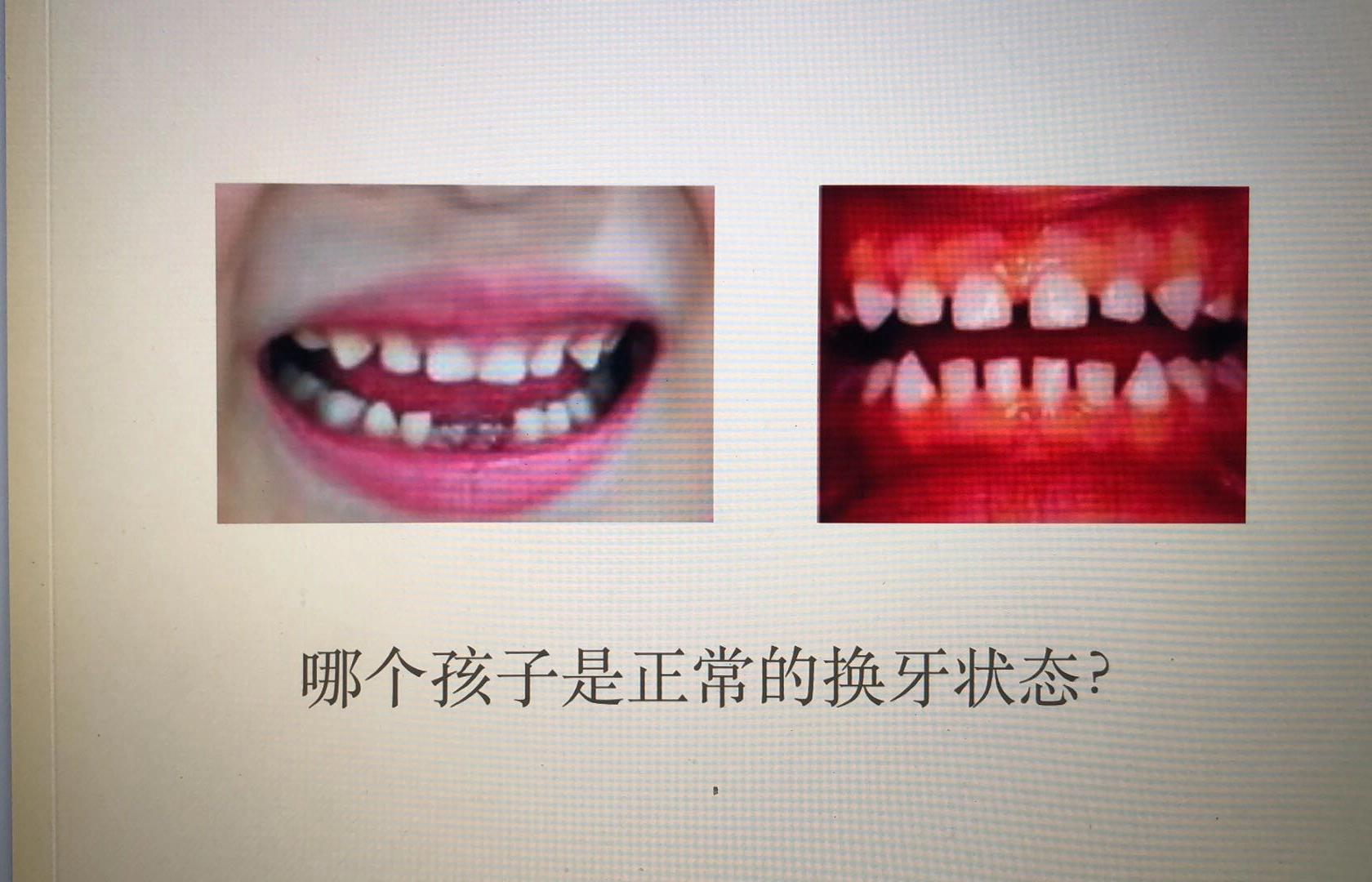 牙齿不整齐蛀牙了,儿童蛀牙新长出来的牙歪吗