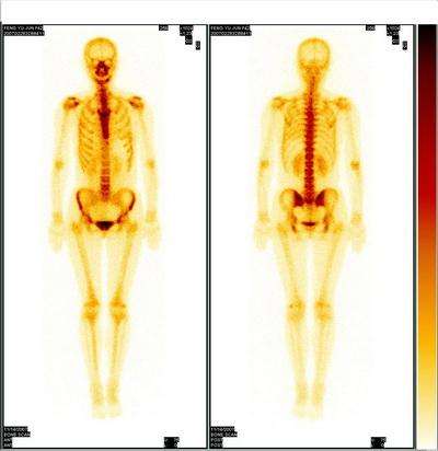 肝癌骨转移疼痛如何止痛,骨转移疼痛用什么药治疗疗效最好