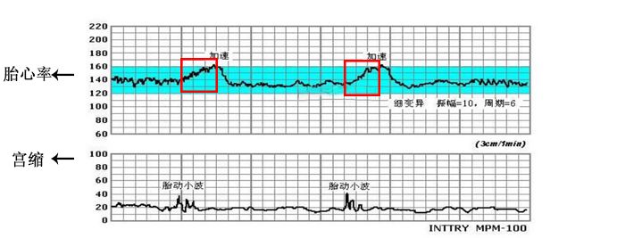 怎么能顺利快速通过胎心监护,怎么使胎心监护快速过关