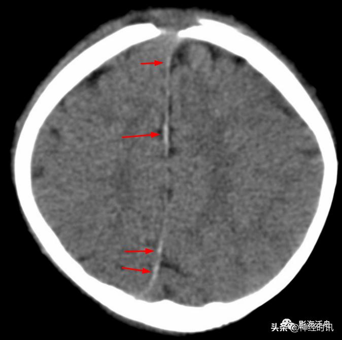 蛛血的临床表现,蛛血ct表现