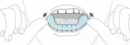 嫌隐形牙套难摘戴?那是你的姿势不正确