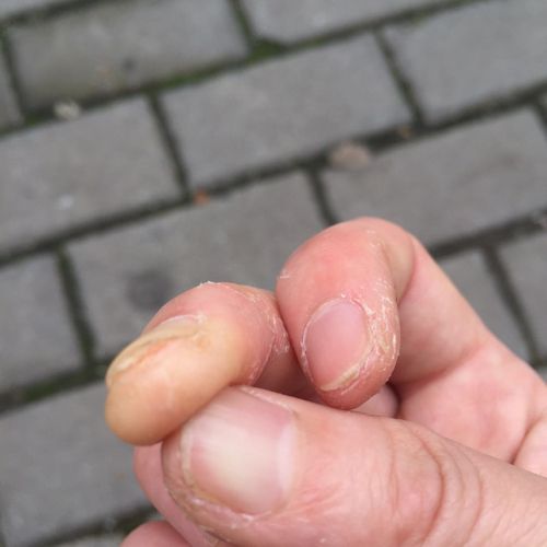 手指反复脱皮是怎么回事该怎么办,手指老是会脱皮是怎么回事