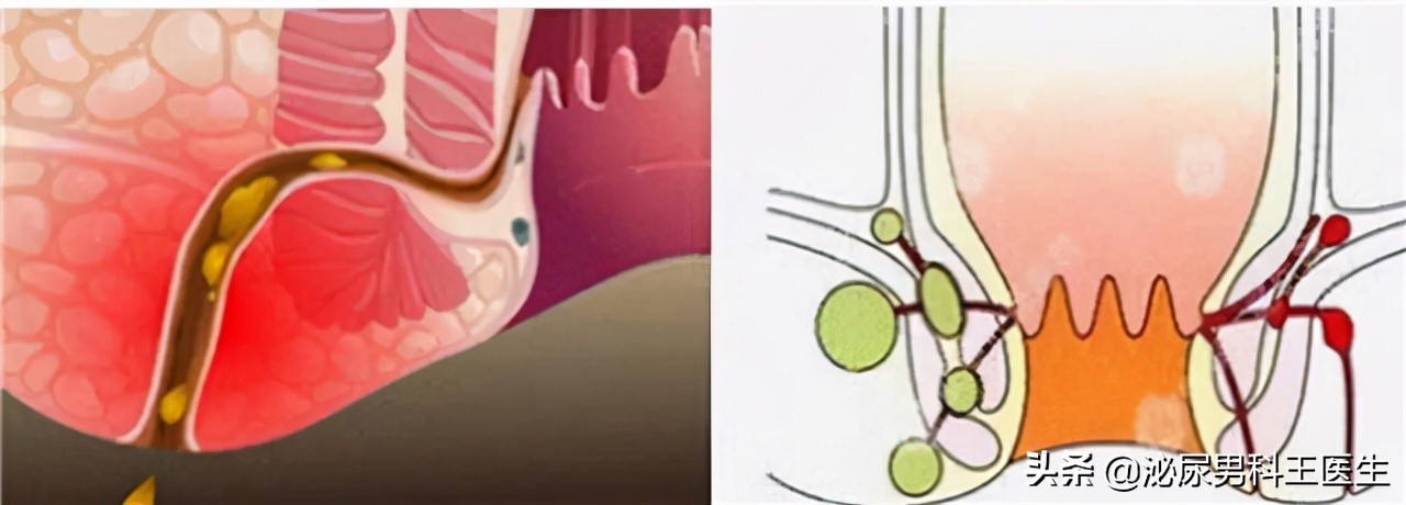 肛瘘不治是不是头疼,肛瘘患者不敢手术