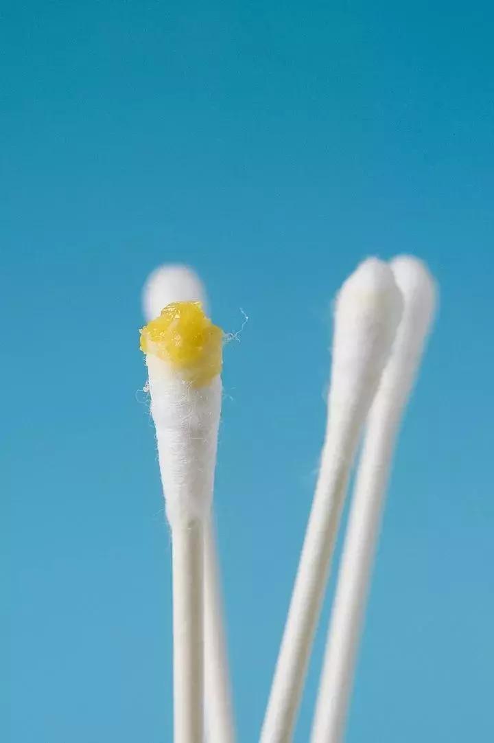 “耳屎”太多被同事吐槽!杭州漂亮姑娘去医院一查,吓得直掉眼泪