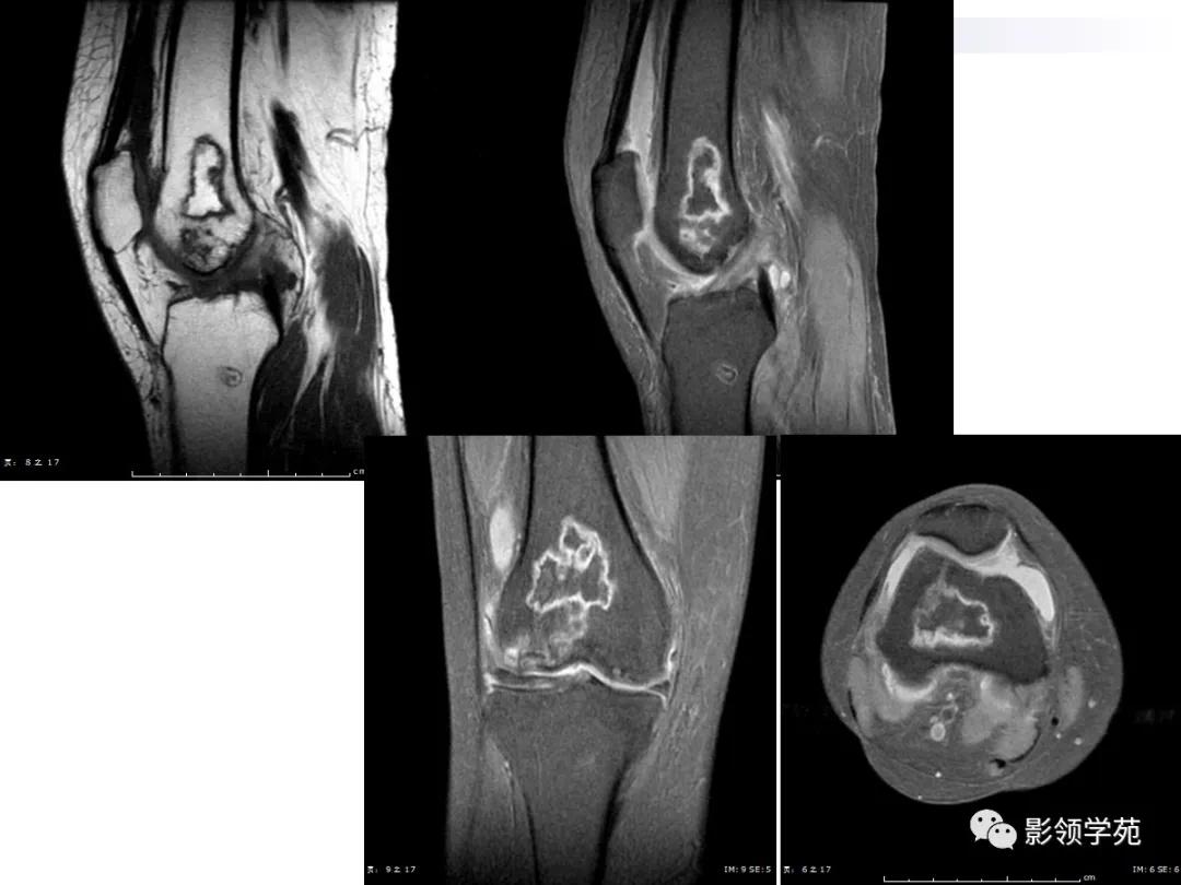 早期骨梗死的ct表现,骨梗死的病理变化