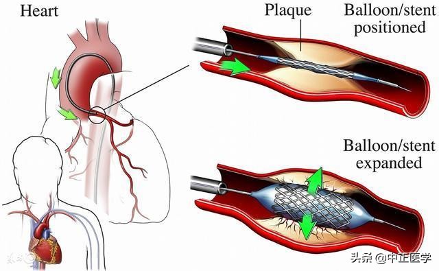 冠心病能治好吗,冠心病能治好吗最真实的经验分享