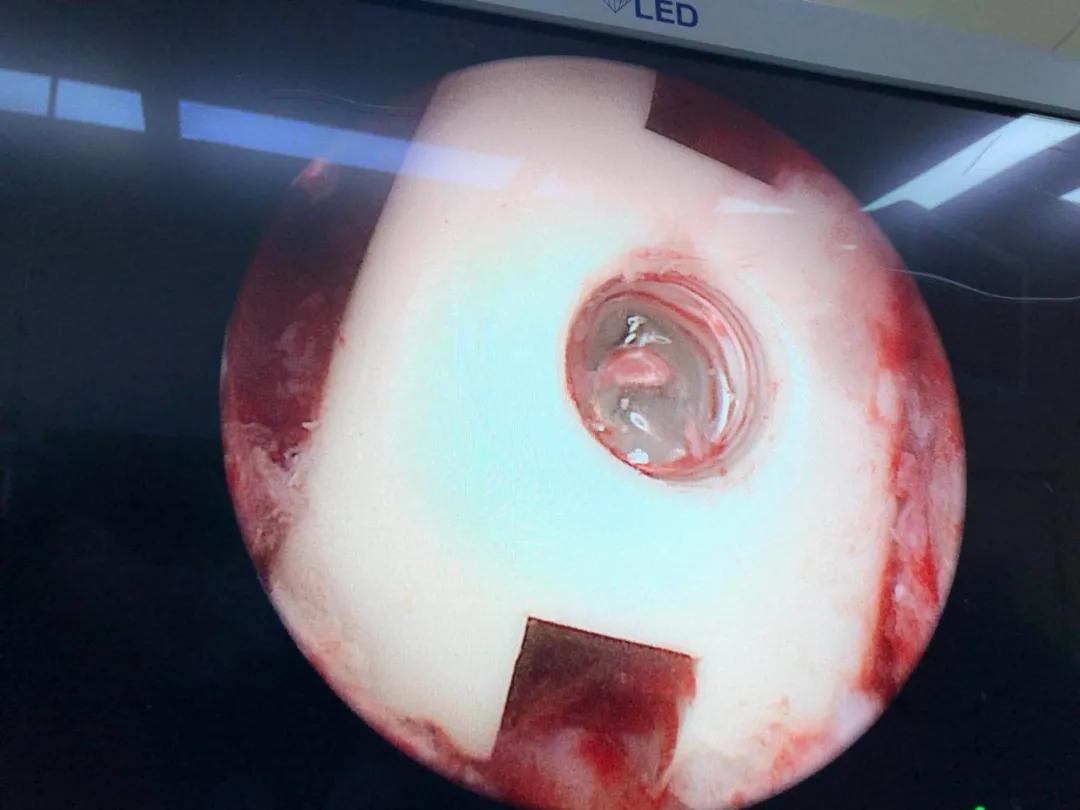 南通首例！海安市中医院骨伤科成功开展UBE技术治疗腰腿痛