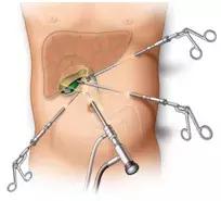 胆囊息肉会癌变吗?听医生的,医生说了算