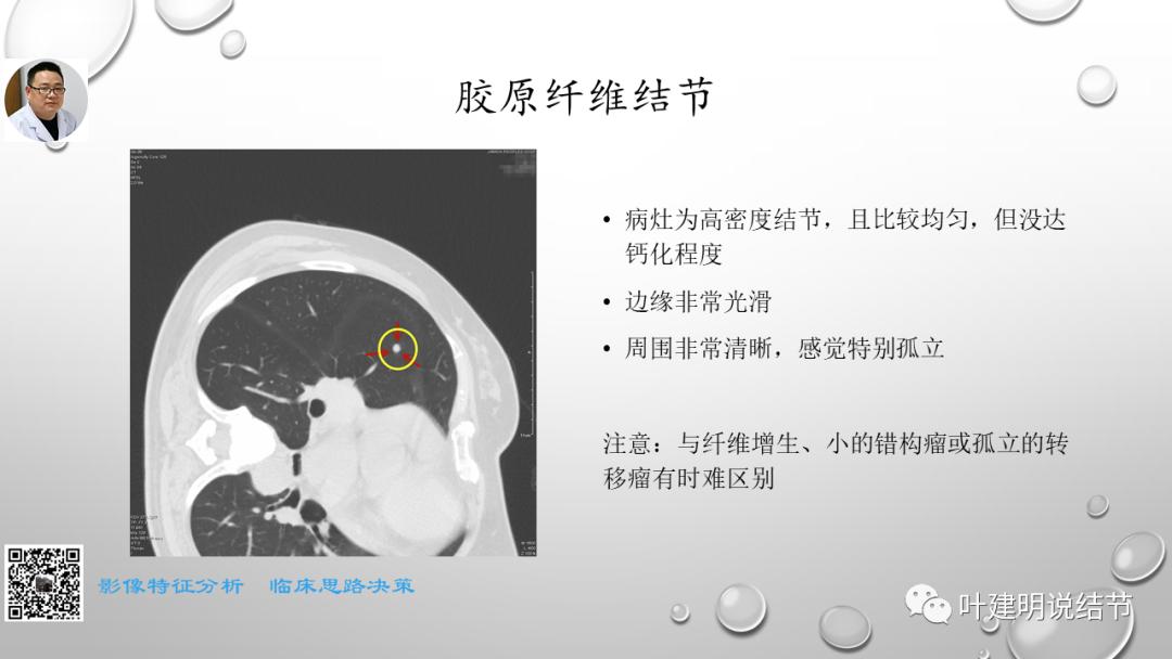 叶建明谈肺实性小结节视频,廖正银教授谈肺结节