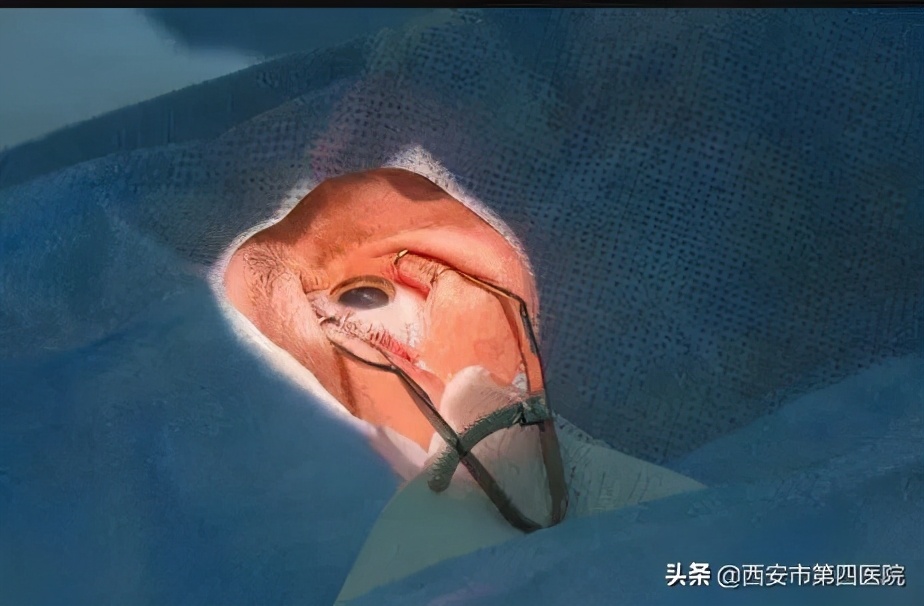 近视眼镜近处清楚远处模糊,近视看清楚近处较模糊