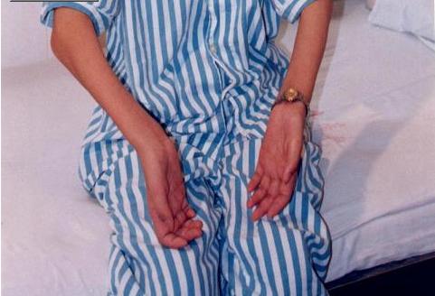 肌无力和肌痉挛的区别,重症肌无力和肌无力差别是什么