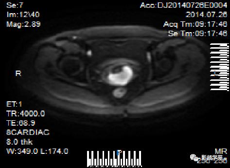 宫颈癌mri诊断,宫颈癌的mr扫描技术