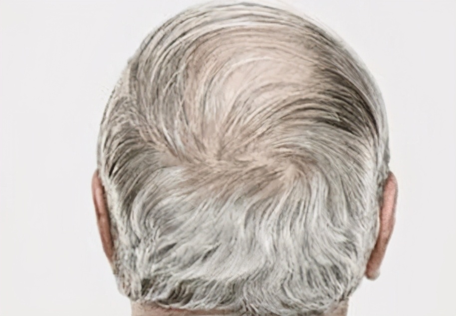 人老了为啥有白发和皱纹,人老了白发变黑发是怎么回事