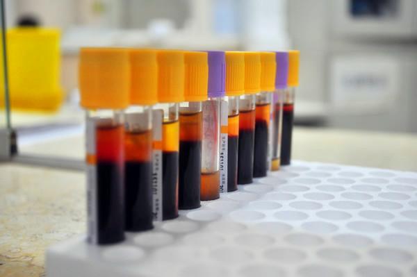 脂蛋白a高对血管有影响吗,脂蛋白a高危险还是低密度高危险