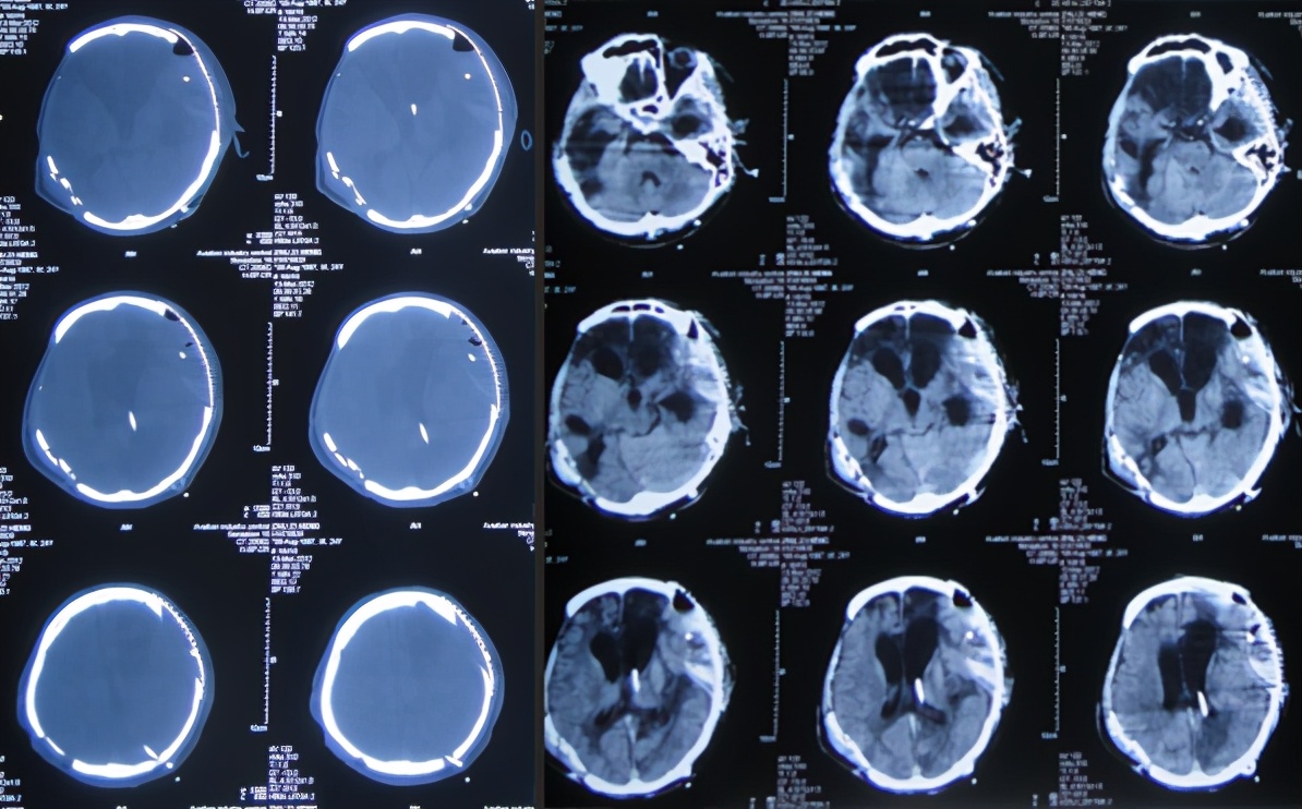 脑受伤开颅手术昏迷,开颅手术后20天发生脑积水引流