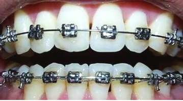 戴牙套戴哪种牙套最好,金属牙套与陶瓷牙套的优缺点
