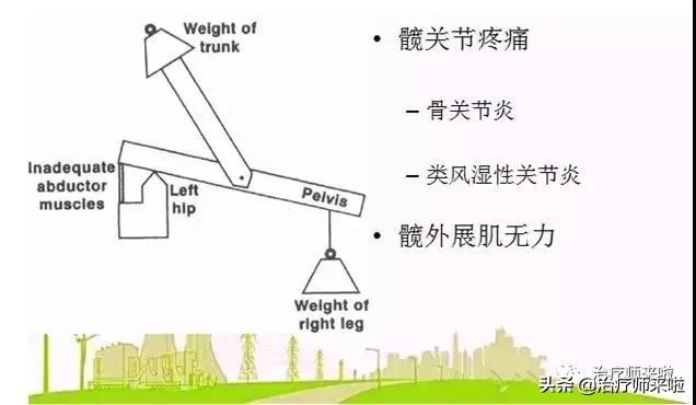 常见的异常步态醉酒步态,步态异常的十大特征有哪些图片