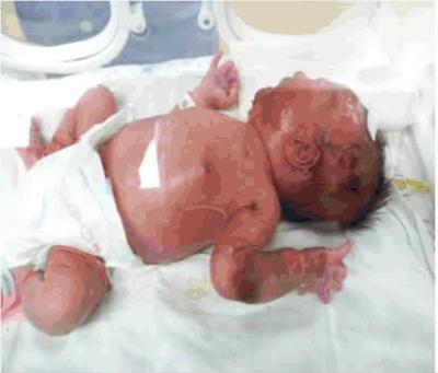 葡萄球菌性烫伤样皮肤综合征表现,葡萄球菌性烫伤样皮肤综合征原因