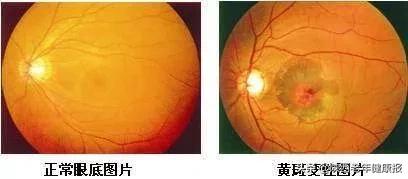 眼睛看不到东西医生说是黄斑病变,最近眼睛里长了黄斑