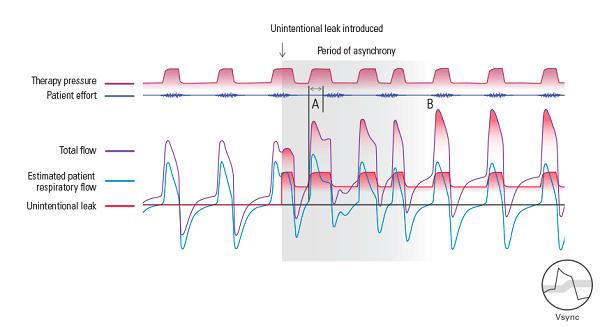 进口呼吸机有用吗,进口呼吸机叫啥