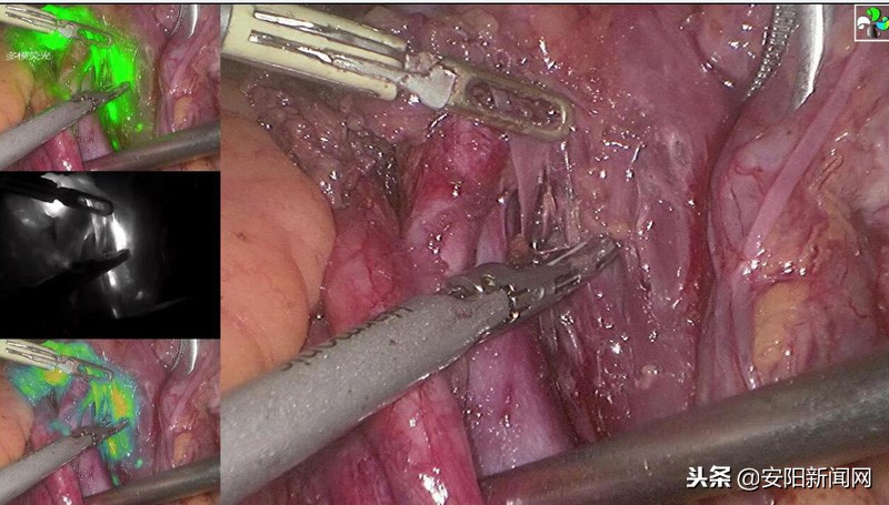 肿瘤微创手术精准导航系统,术中肿瘤定位系统