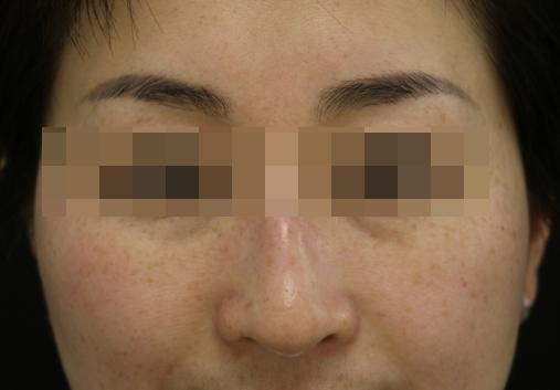 青褐斑怎么内调最好,褐青色斑怎么护理