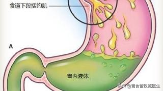 胃酸是怎么来的,为什么我感觉胃里是酸的,嘴巴也是酸的?