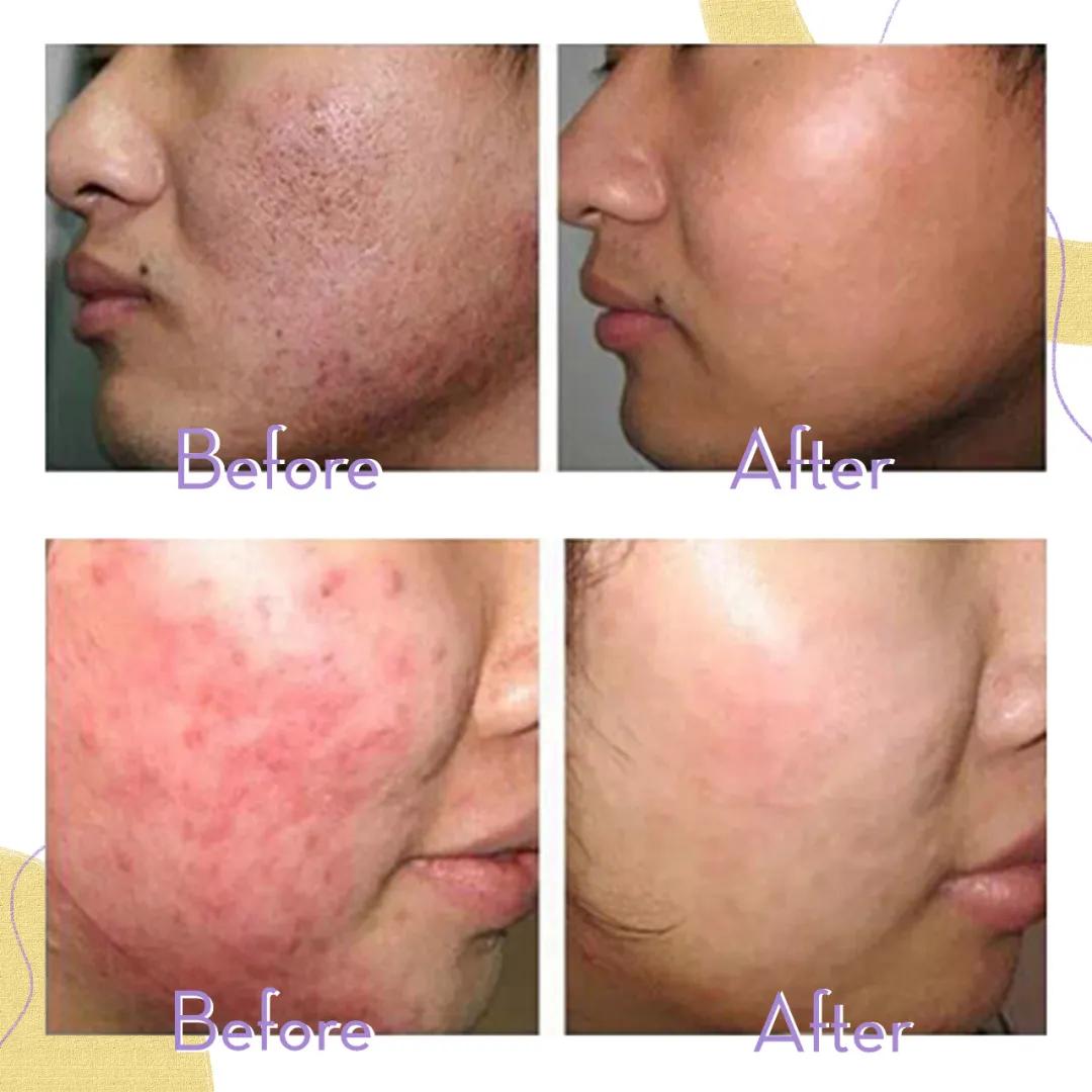 医美做什么能永远不长痘,脸很多痘坑做什么医美