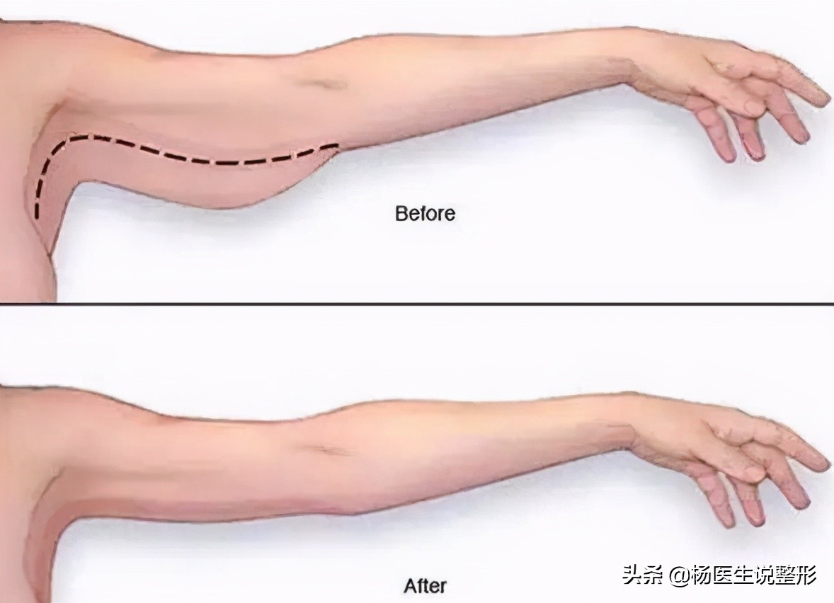 吸脂手术有哪几种类型,吸脂手术很微创