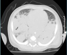 医护奋战27小时救回羊水栓塞产妇,广西驰援武汉护士抢救26天
