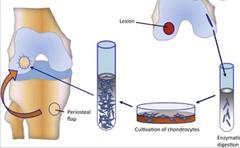 关节软骨损伤为什么难以治疗?听听医生怎么说