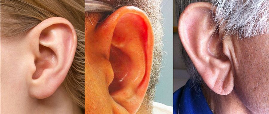 有酒糟鼻,有酒糟鼻就说明是要得糖尿病吗