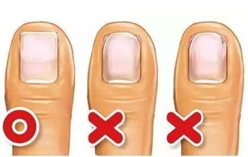 甲沟炎剪指甲的正确方式,甲沟炎剪指甲的正确方法