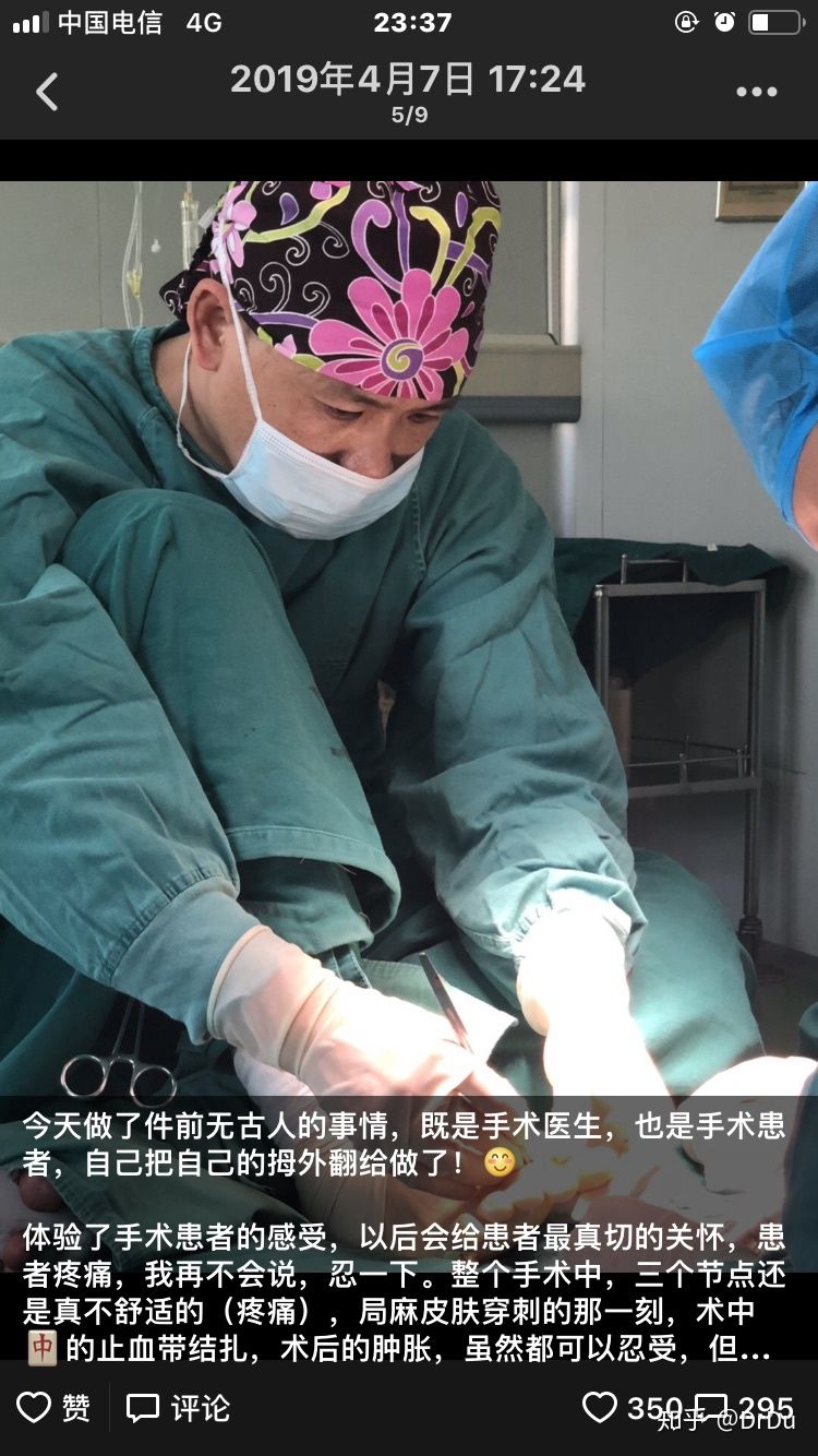 拇外翻微创手术的全过程,医生自己给自己做拇外翻手术