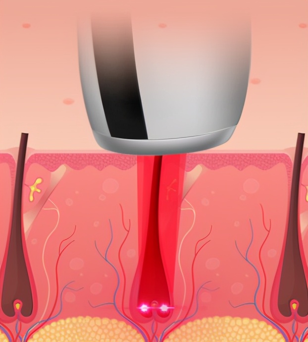 毛发脱毛,哪种脱毛才是永久性脱毛