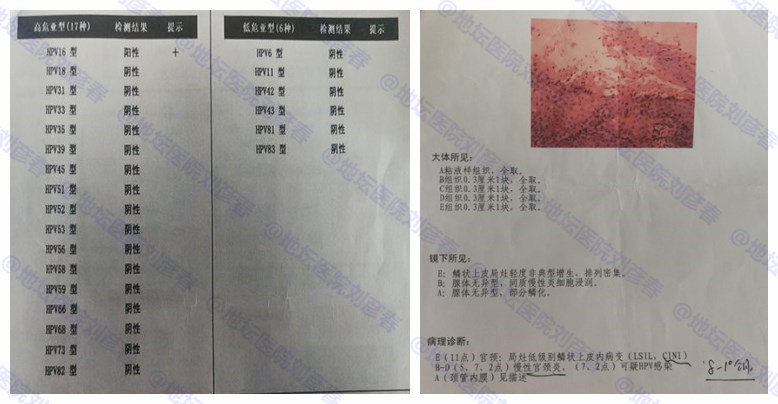 干扰素治非典型鳞状细胞吗,hpv低级病变用干扰素