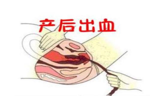有利于预防产后出血的措施有,羊产后出血治疗土办法