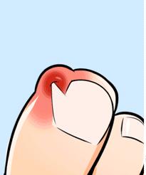 得了甲沟炎太疼了怎么办,甲沟炎疼痛难忍最有效办法