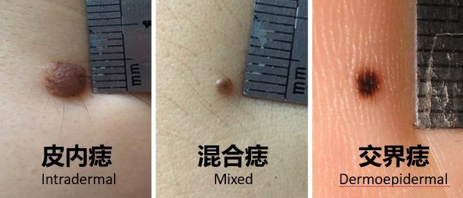 激光点痣不小心照了紫灯怎么办,切除黑色素痣可能癌变吗