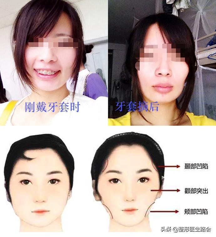 戴牙套导致脸颊凹陷怎么办,戴牙套导致太阳穴突出