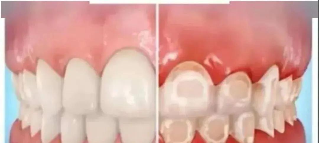 牙齿脱矿用含氟牙膏有用吗,一岁半宝宝牙齿脱矿怎么办