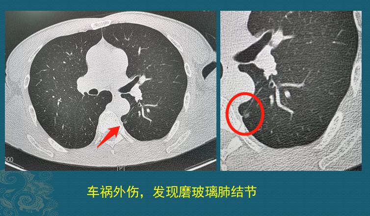 3个肺结节,3年肺结节增长了0.3毫米严重吗